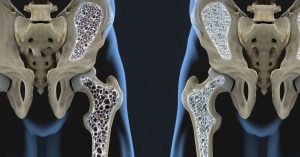 Kemik Erimesi Nedir?